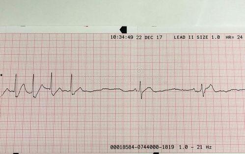 吃瓜心电图视频,揭秘瓜界“心跳”的秘密